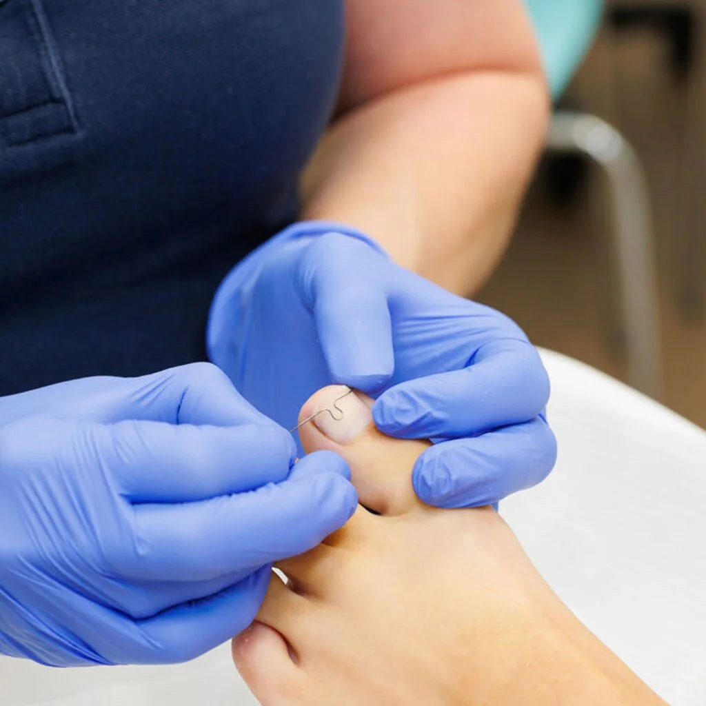 Nagelbeugel behandeling